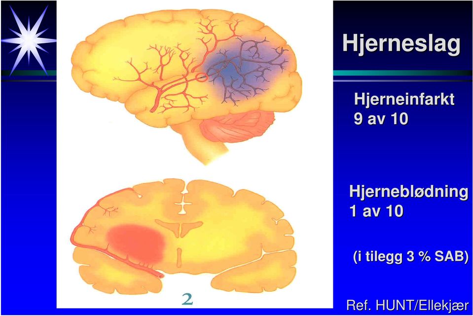 Hjerneinfarkt 9 av 10