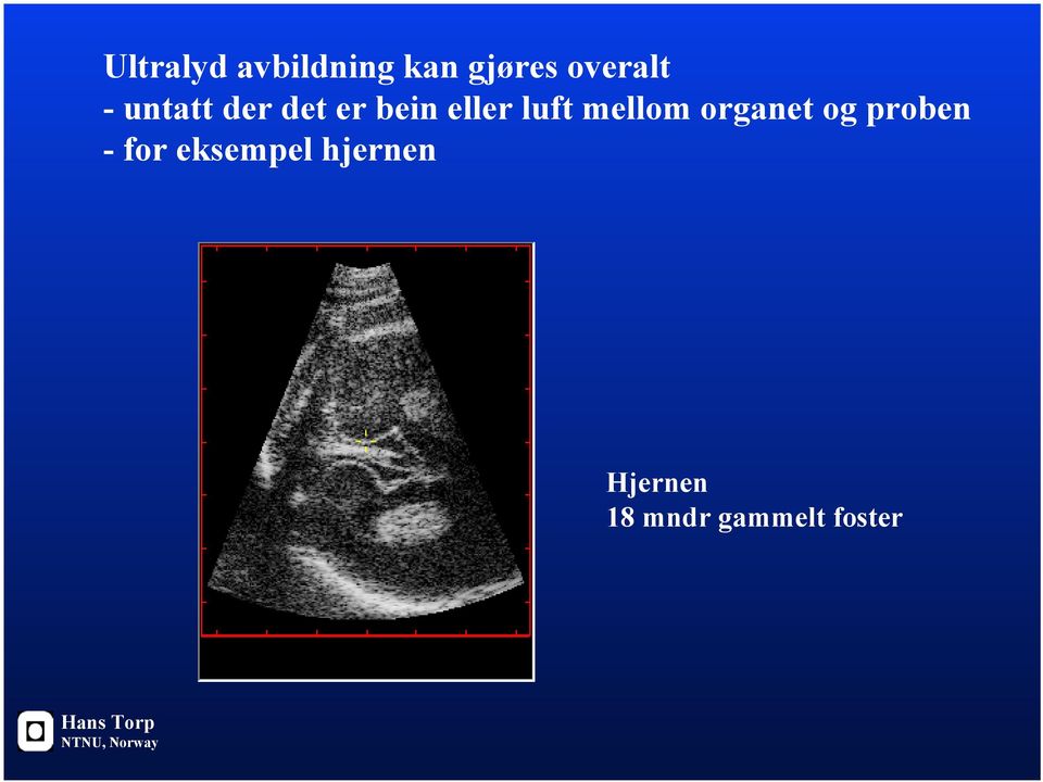 organet og proben - for eksempel hjernen