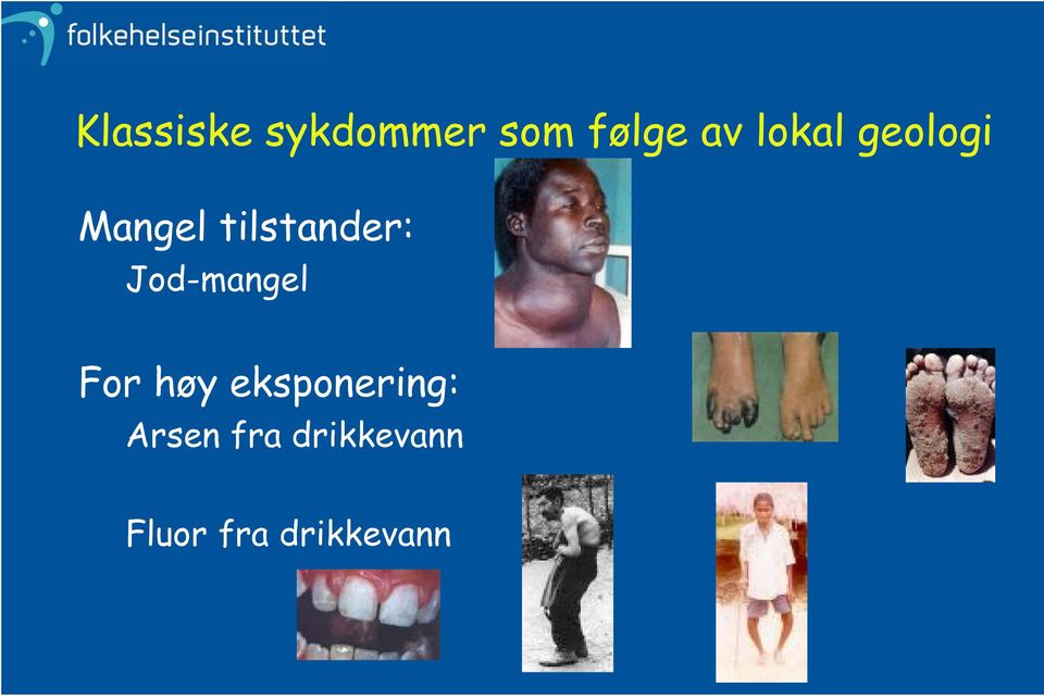 Jod-mangel For høy eksponering: