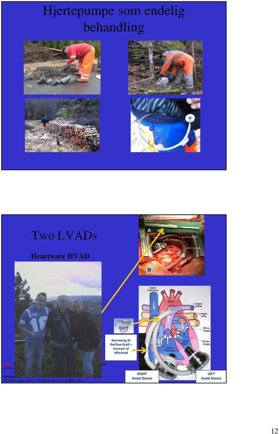 , Long-term biventricular support with the Heartware implantable continuous flow pump. J Heart Lung Transplant, 2010. 29(7): p. 822-4.