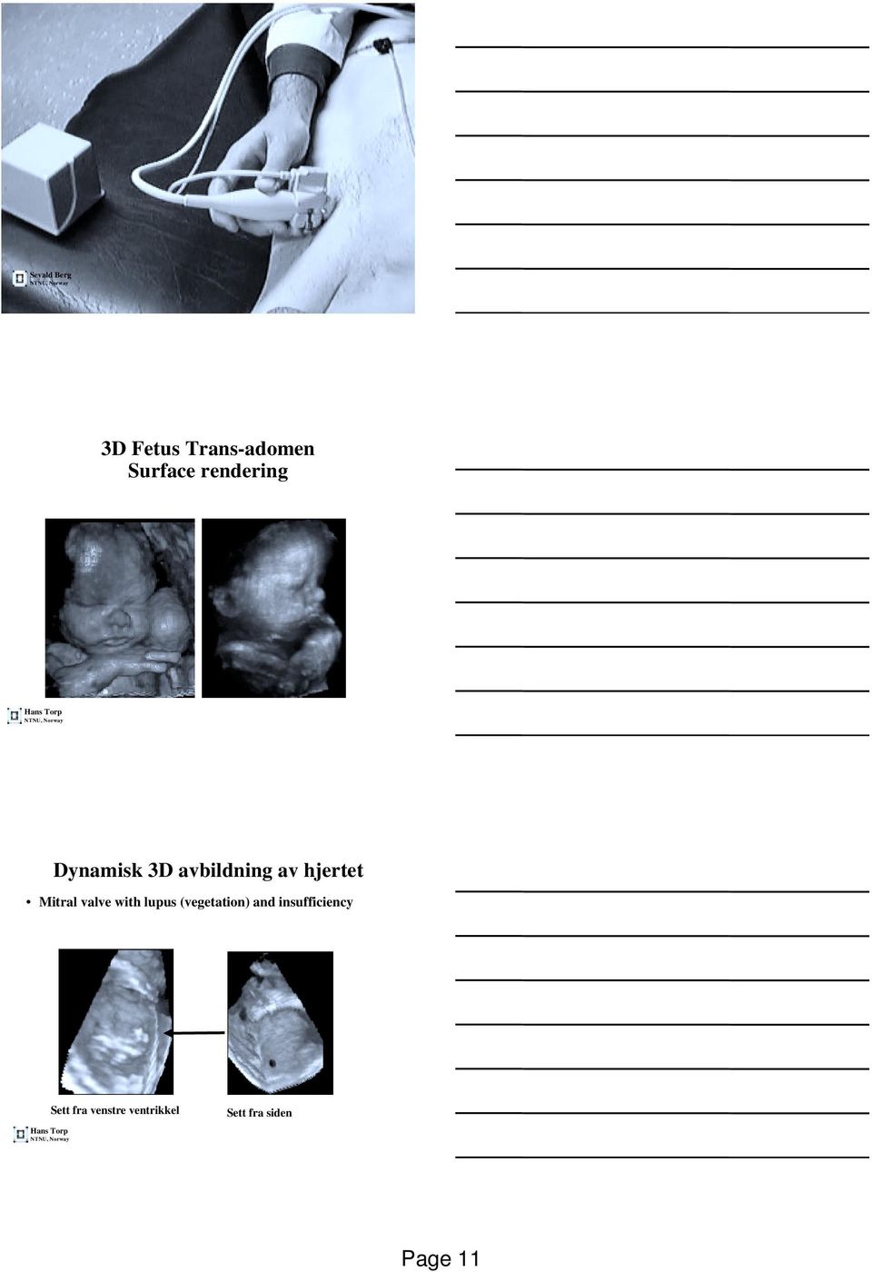 Mitral valve with lupus (vegetation) and