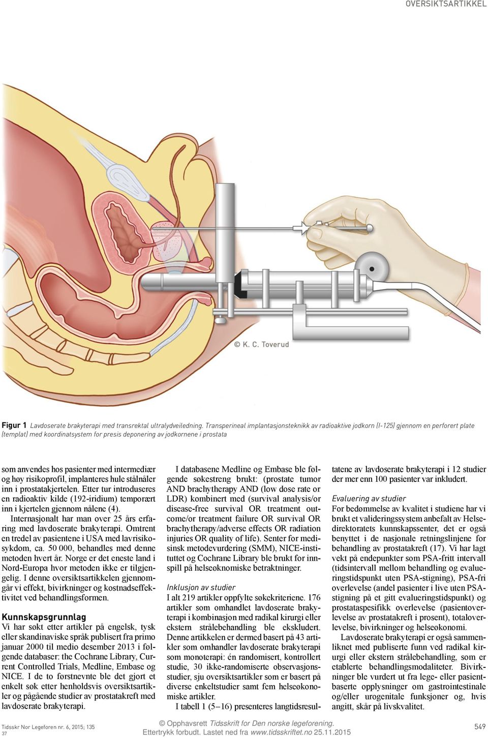med intermediær og høy risikoprofil, implanteres hule stålnåler inn i prostatakjertelen. Etter tur introduseres en radioaktiv kilde (192-iridium) temporært inn i kjertelen gjennom nålene (4).