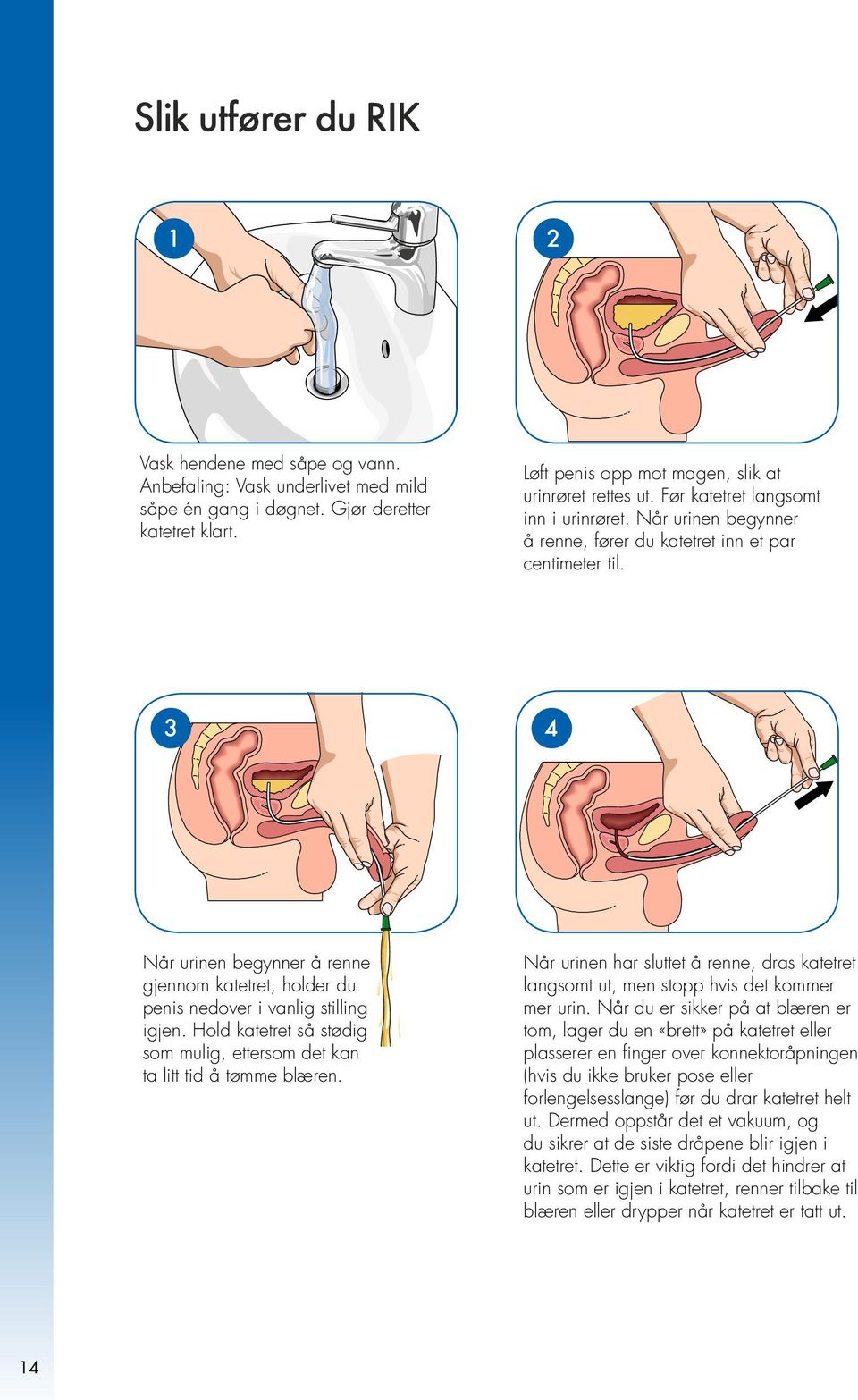 3 4 Når urinen begynner å renne gjennom katetret, holder du penis nedover i vanlig stilling igjen. Hold katetret så stødig som mulig, ettersom det kan ta litt tid å tømme blæren.