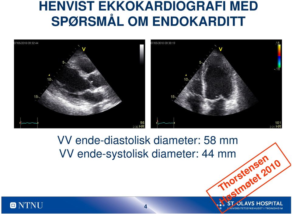 ende-diastolisk diameter: 58