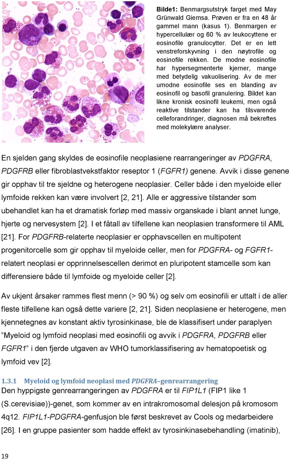 Av de mer umodne eosinofile ses en blanding av eosinofil og basofil granulering.