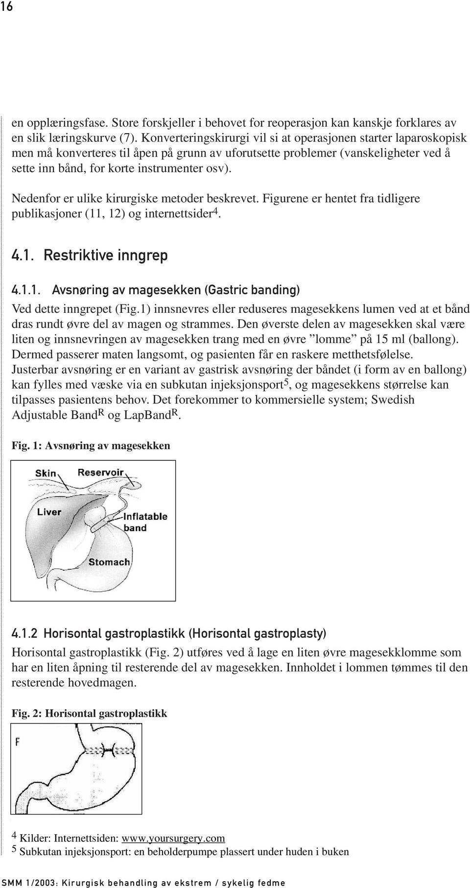 Nedenfor er ulike kirurgiske metoder beskrevet. Figurene er hentet fra tidligere publikasjoner (11, 12) og internettsider 4. 4.1. Restriktive inngrep 4.1.1. Avsnøring av magesekken (Gastric banding) Ved dette inngrepet (Fig.