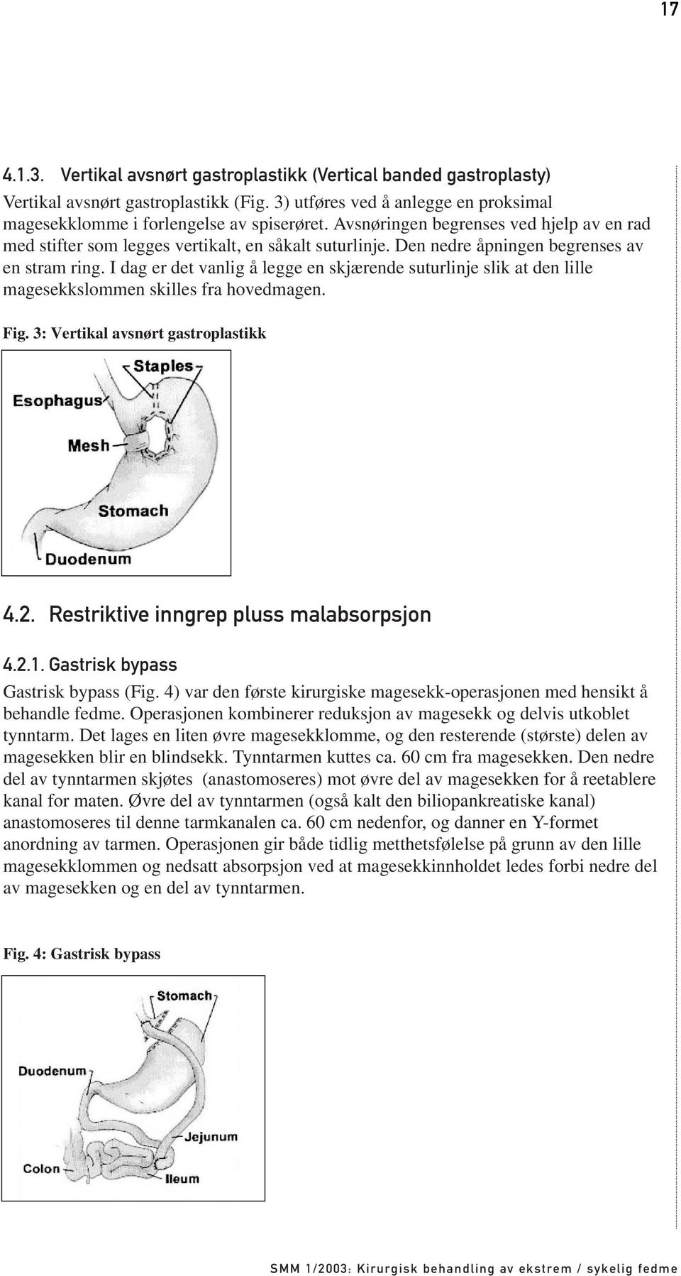 I dag er det vanlig å legge en skjærende suturlinje slik at den lille magesekkslommen skilles fra hovedmagen. Fig. 3: Vertikal avsnørt gastroplastikk 4.2. Restriktive inngrep pluss malabsorpsjon 4.2.1.