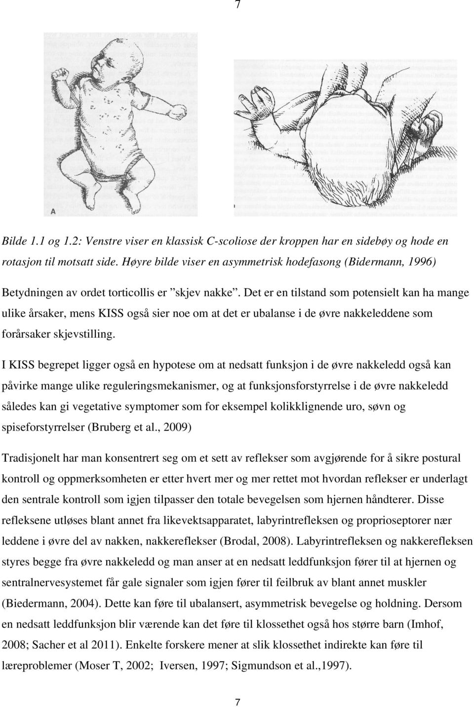 Det er en tilstand som potensielt kan ha mange ulike årsaker, mens KISS også sier noe om at det er ubalanse i de øvre nakkeleddene som forårsaker skjevstilling.