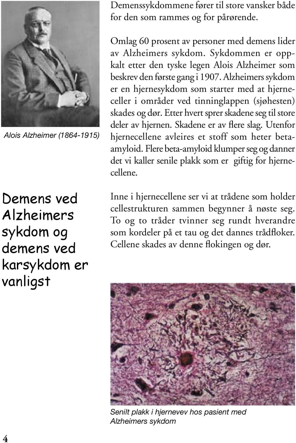 Sykdommen er oppkalt etter den tyske legen Alois Alzheimer som beskrev den første gang i 1907.