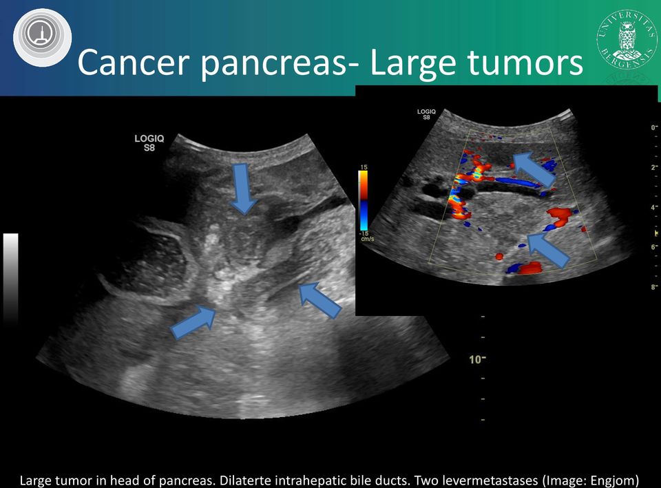 Dilaterte intrahepatic bile ducts.