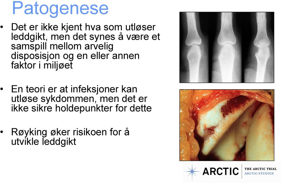 miljøet En teori er at infeksjoner kan utløse sykdommen, men det er