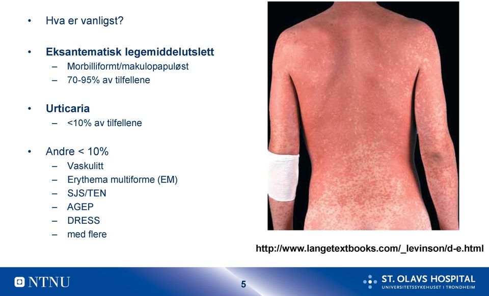 70-95% av tilfellene Urticaria <10% av tilfellene Andre < 10%