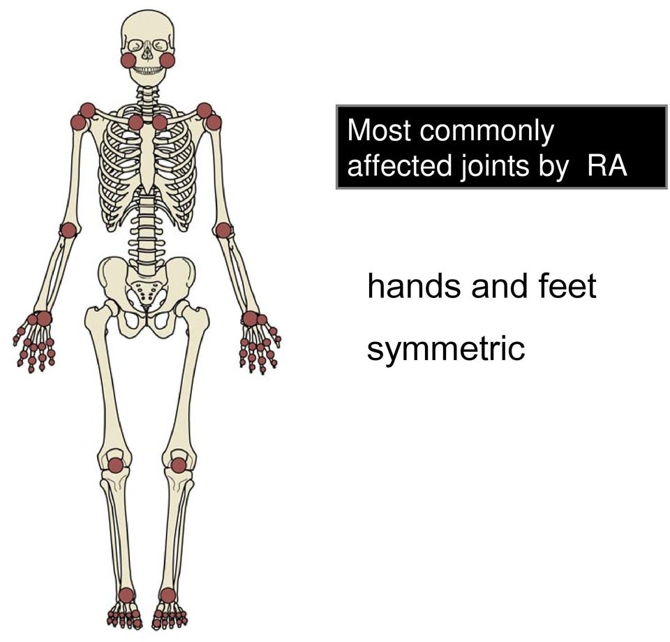 joints by RA