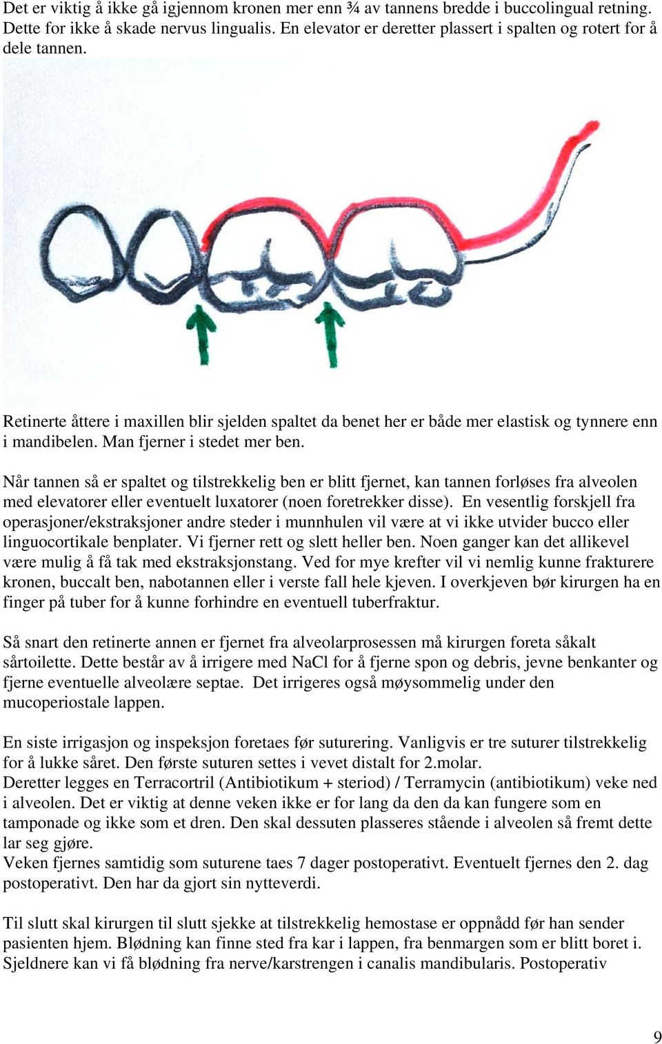 Man fjerner i stedet mer ben. Når tannen så er spaltet og tilstrekkelig ben er blitt fjernet, kan tannen forløses fra alveolen med elevatorer eller eventuelt luxatorer (noen foretrekker disse).