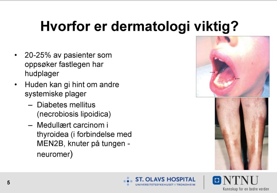 kan gi hint om andre systemiske plager Diabetes mellitus