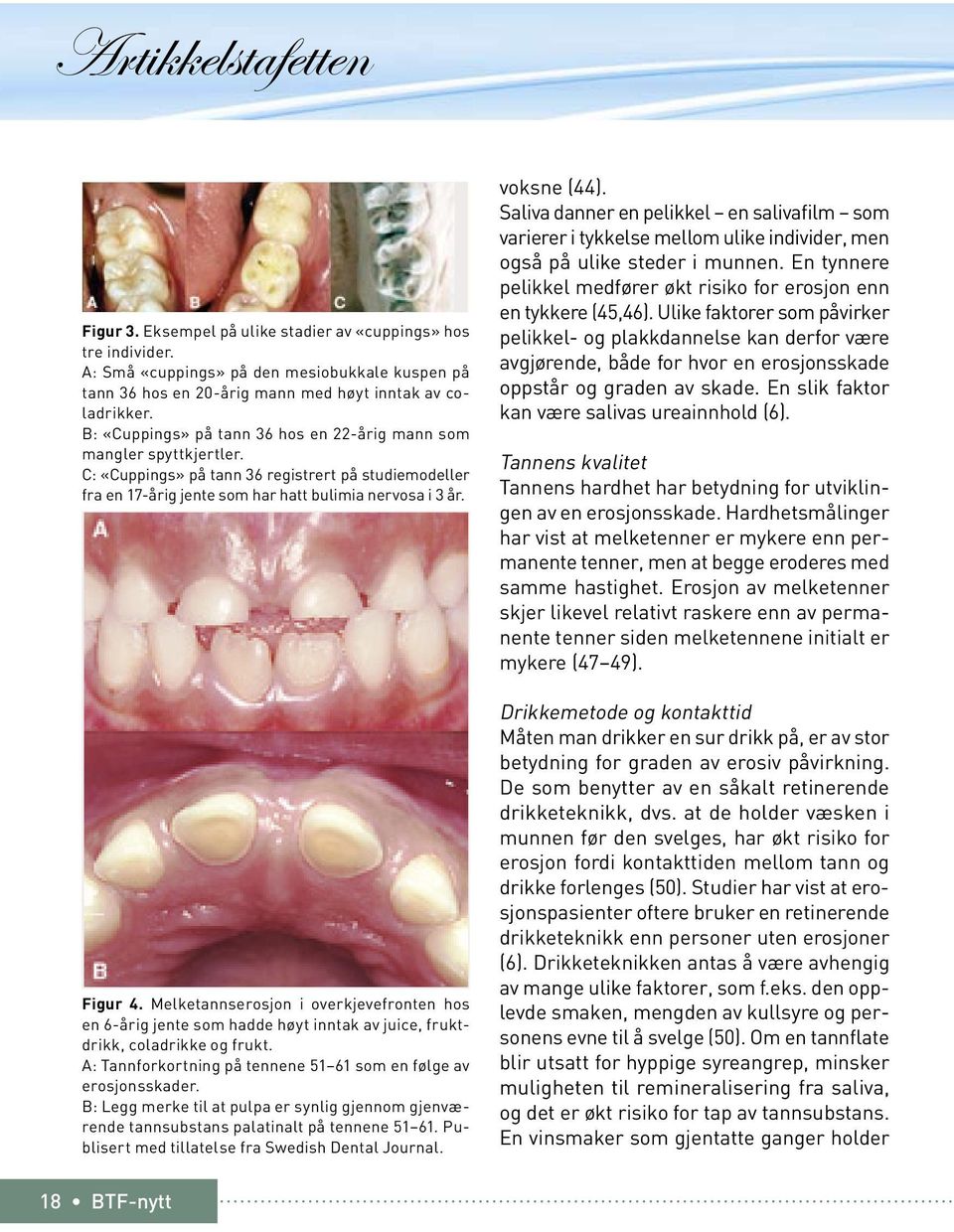 Cervikale defekter betraktes ofte som tannbørsteskader.