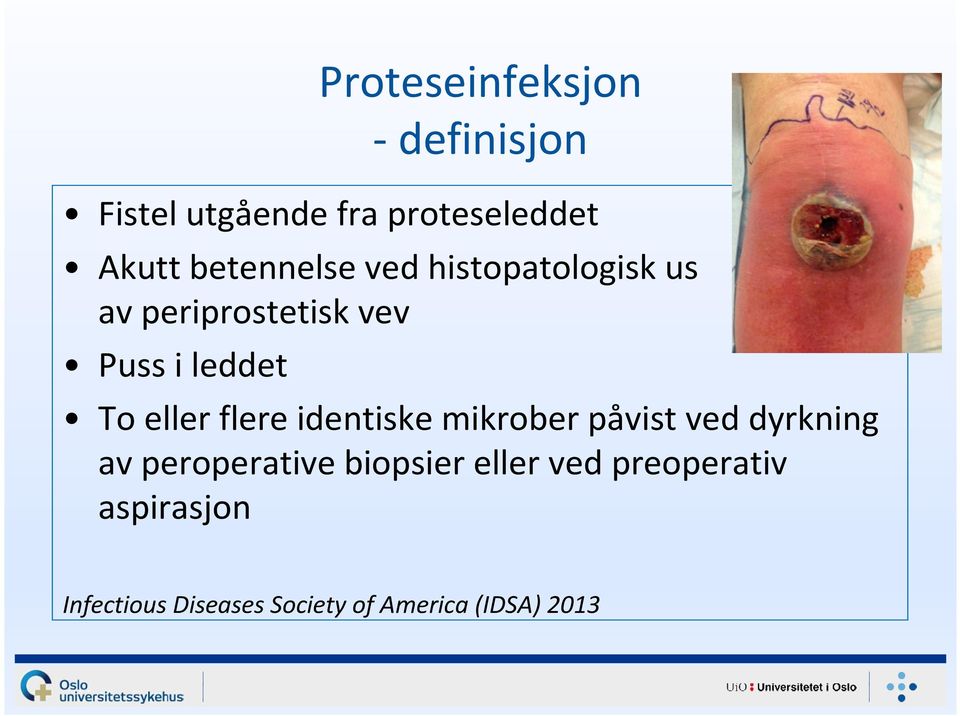 eller flere identiske mikrober påvist ved dyrkning av peroperative biopsier