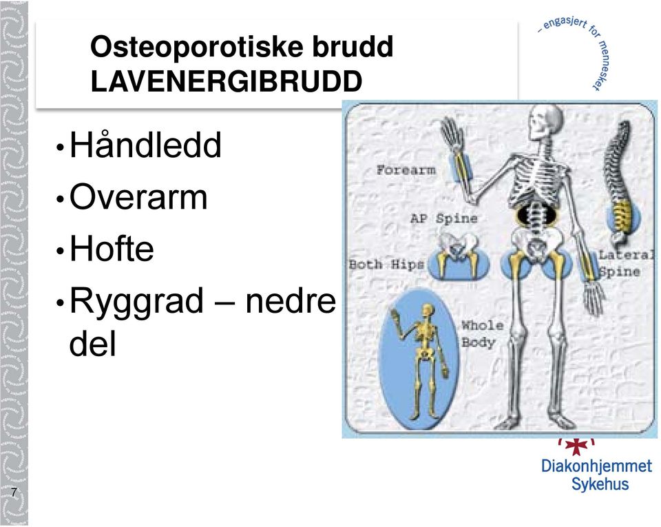 Osteoporotiske brudd