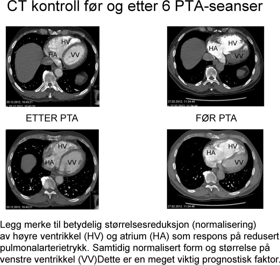 (HV) og atrium (HA) som respons på redusert pulmonalarterietrykk.