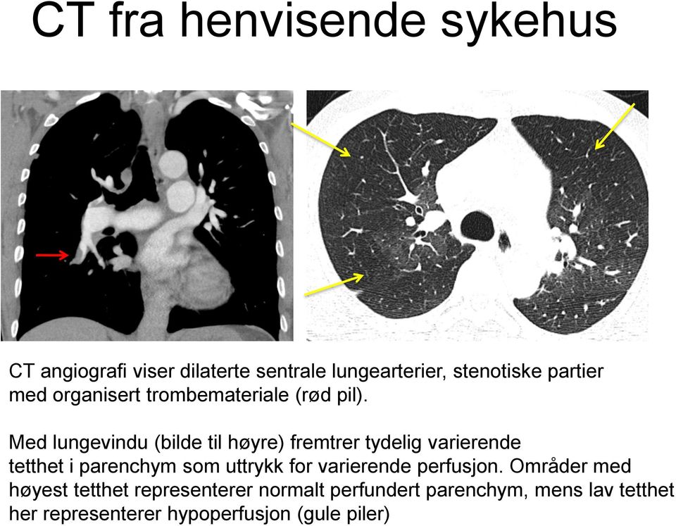 Med lungevindu (bilde til høyre) fremtrer tydelig varierende tetthet i parenchym som uttrykk for