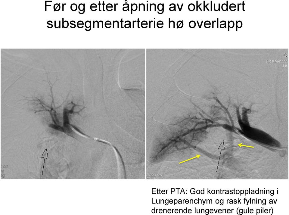 God kontrastoppladning i Lungeparenchym