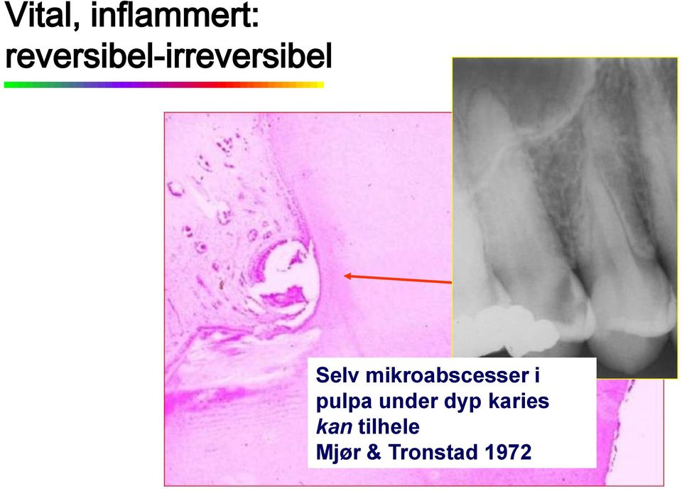 mikroabscesser i pulpa under