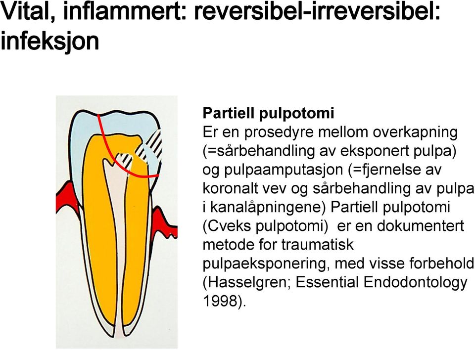 sårbehandling av pulpa i kanalåpningene) Partiell pulpotomi (Cveks pulpotomi) er en dokumentert