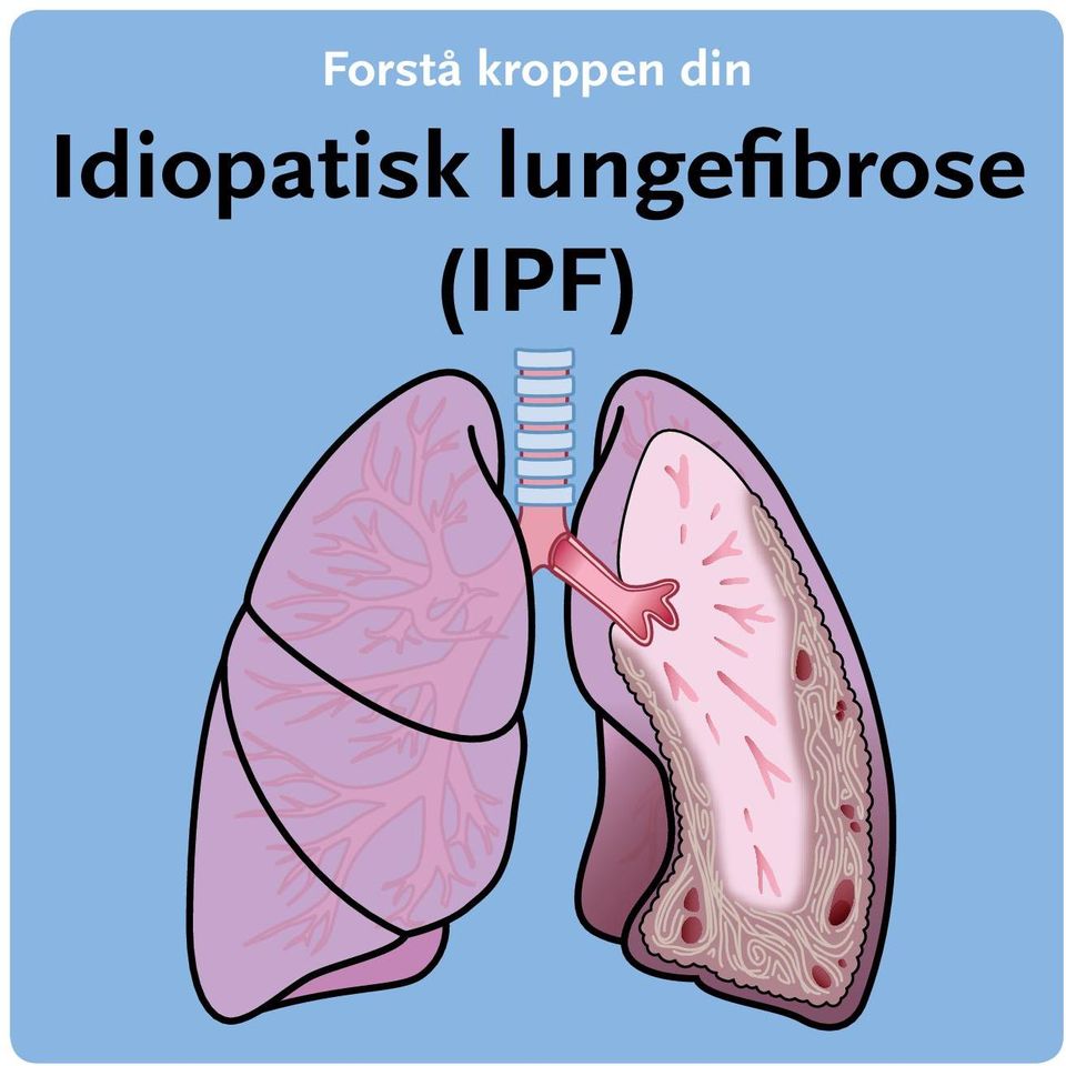 Idiopatisk