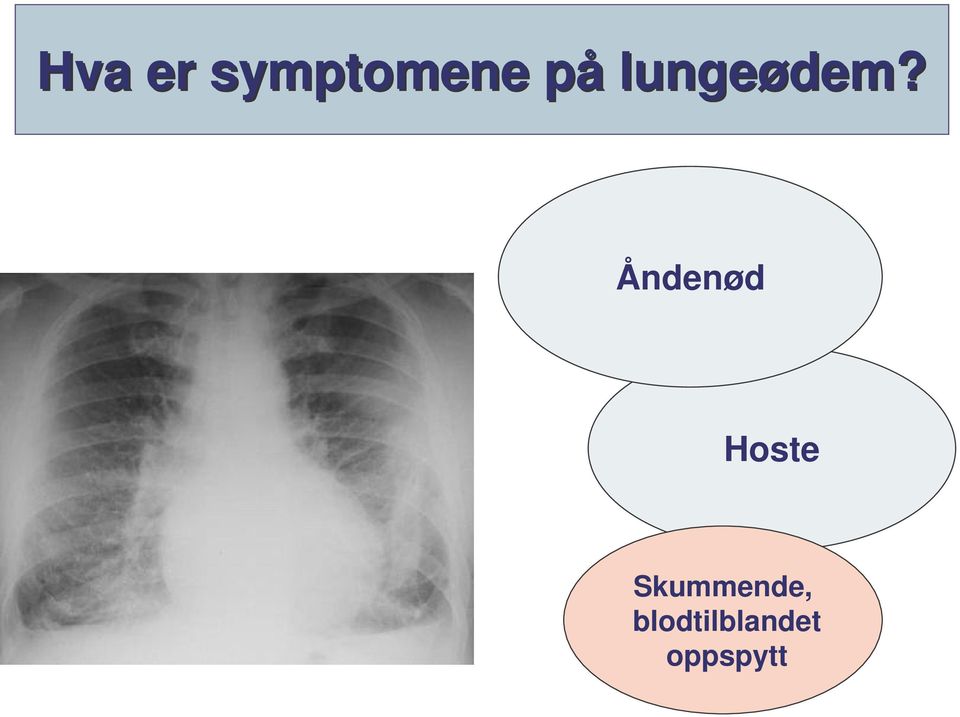 Åndenød Hoste