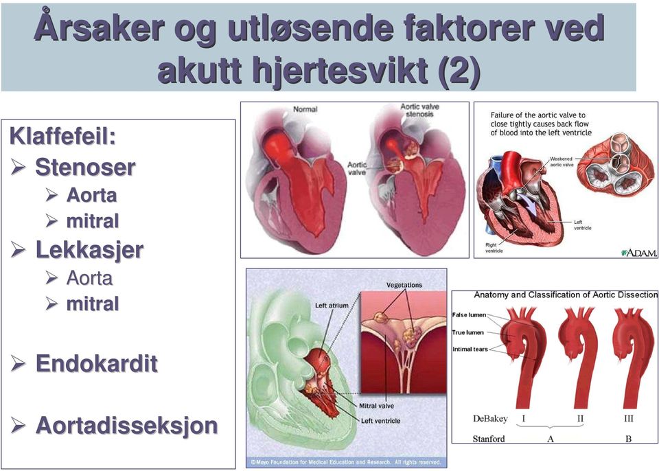 Lekkasjer Aorta mitral Endokardit