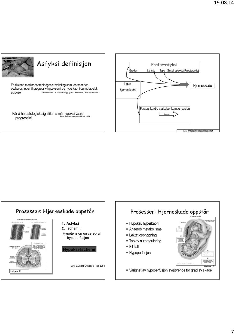 og metabolsk acidose World federation of Neurology group Dev Med Child Neurol1993 Ingen hjerneskade Hjerneskade Får å ha patologisk signifikans må hypoksi være progressiv! Low J.