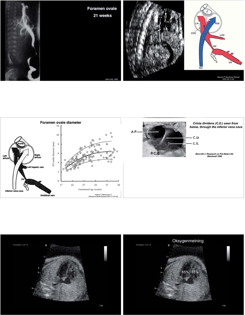 ) seen from below, through the inferior vena cava Foramen ovale outlet area (cm^2) N =