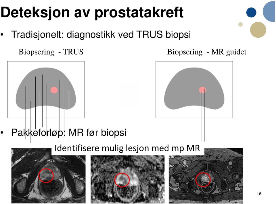 TRUS Biopsering - MR guidet Pakkeforløp: MR