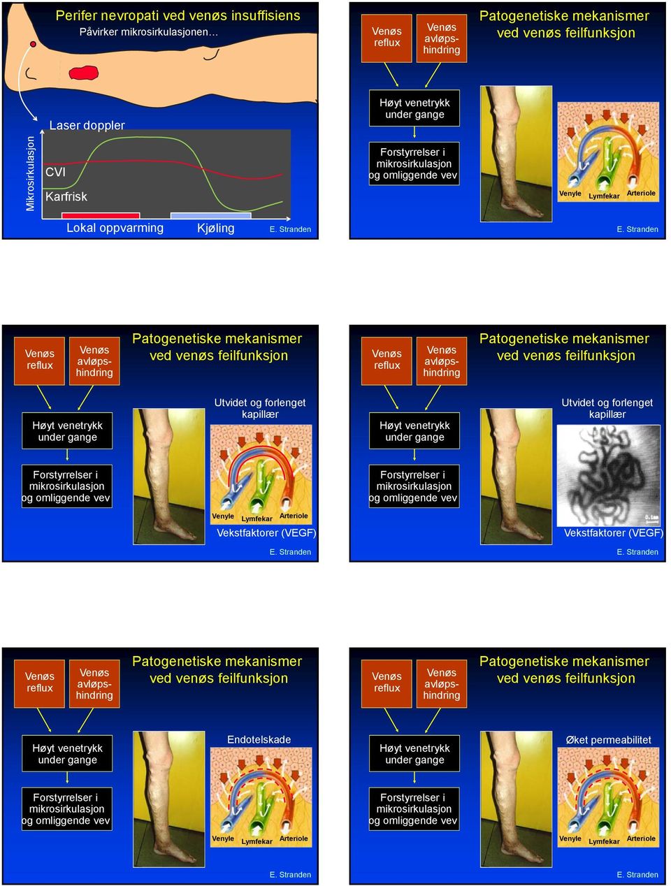 avløpshindring Patogenetiske mekanismer ved venøs feilfunksjon Høyt venetrykk under gange Utvidet og forlenget kapillær Høyt venetrykk under gange Utvidet og forlenget kapillær Forstyrrelser i