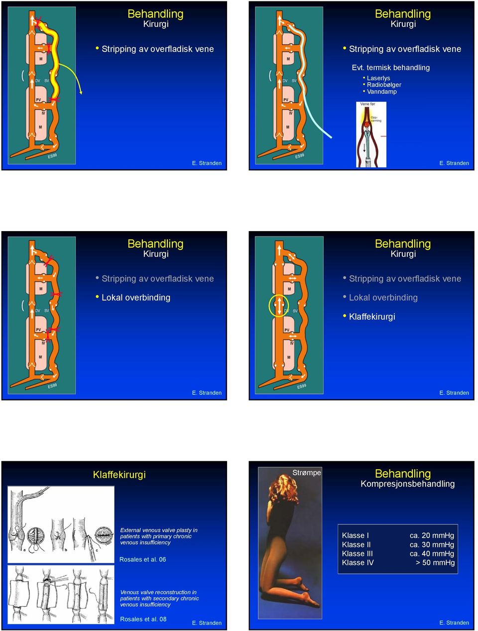 overfladisk vene Lokal overbinding Klaffekirurgi Klaffekirurgi Strømpe Behandling External venous valve plasty in patients with primary chronic venous