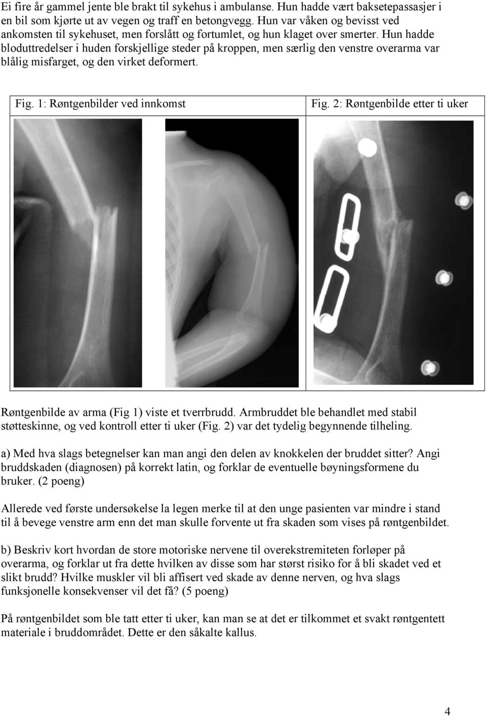 Hun hadde bloduttredelser i huden forskjellige steder på kroppen, men særlig den venstre overarma var blålig misfarget, og den virket deformert. Fig. 1: Røntgenbilder ved innkomst Fig.