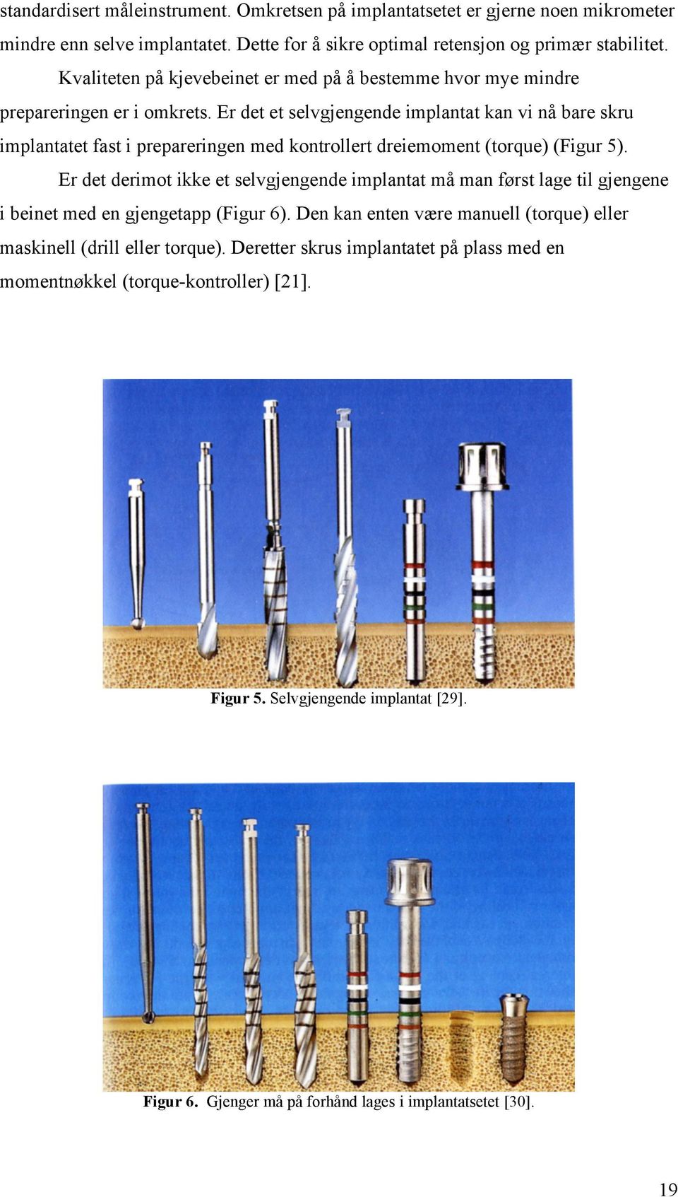 Er det et selvgjengende implantat kan vi nå bare skru implantatet fast i prepareringen med kontrollert dreiemoment (torque) (Figur 5).