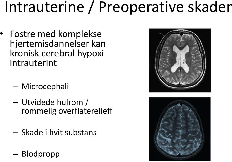 hypoxi intrauterint Microcephali Utvidede hulrom /
