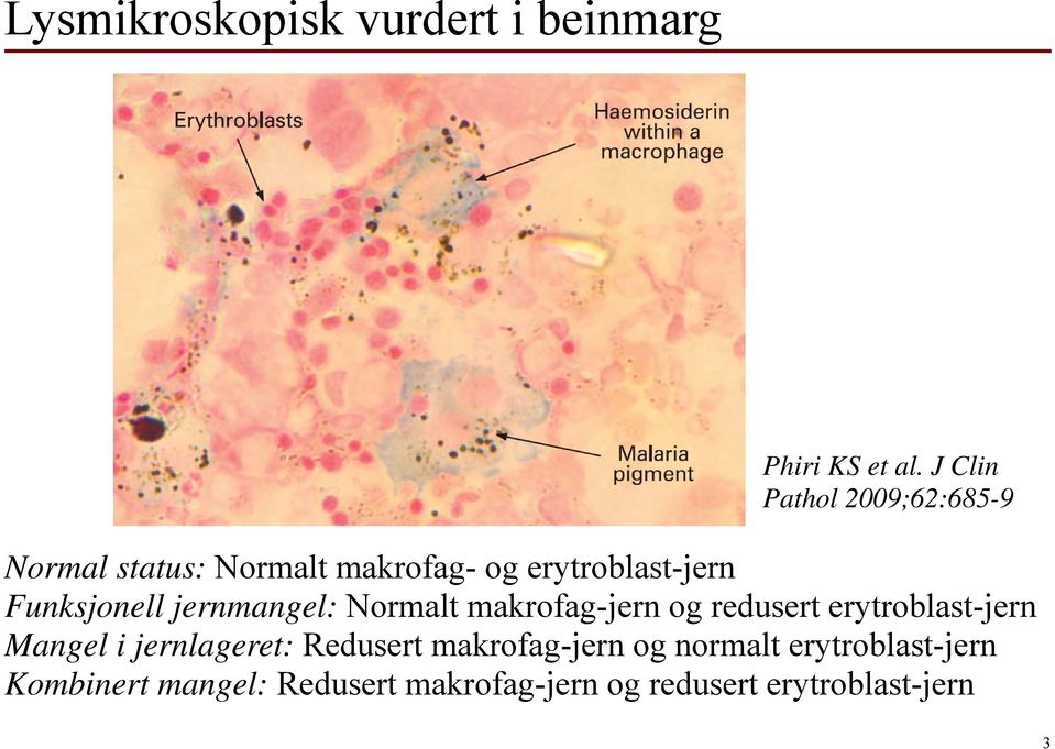 Funksjonell jernmangel: Normalt makrofag-jern og redusert erytroblast-jern Mangel i