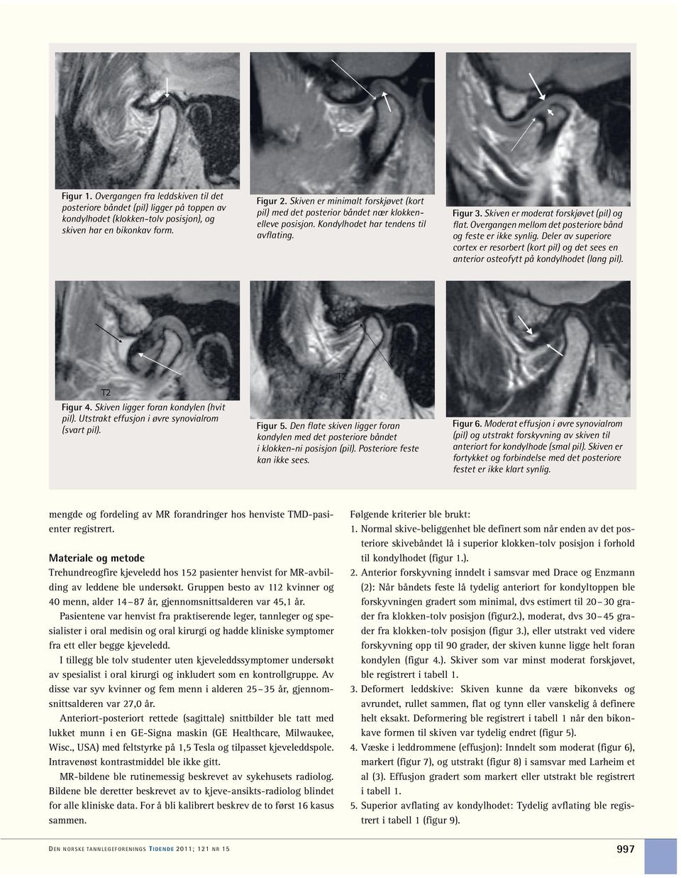 Utstrakt effusjon i øvre synovialrom (svart pil). Figur 2. Skiven er minimalt forskjøvet (kort pil) med det posterior båndet nær klokkenelleve posisjon. Kondylhodet har tendens til avflating. Figur 5.