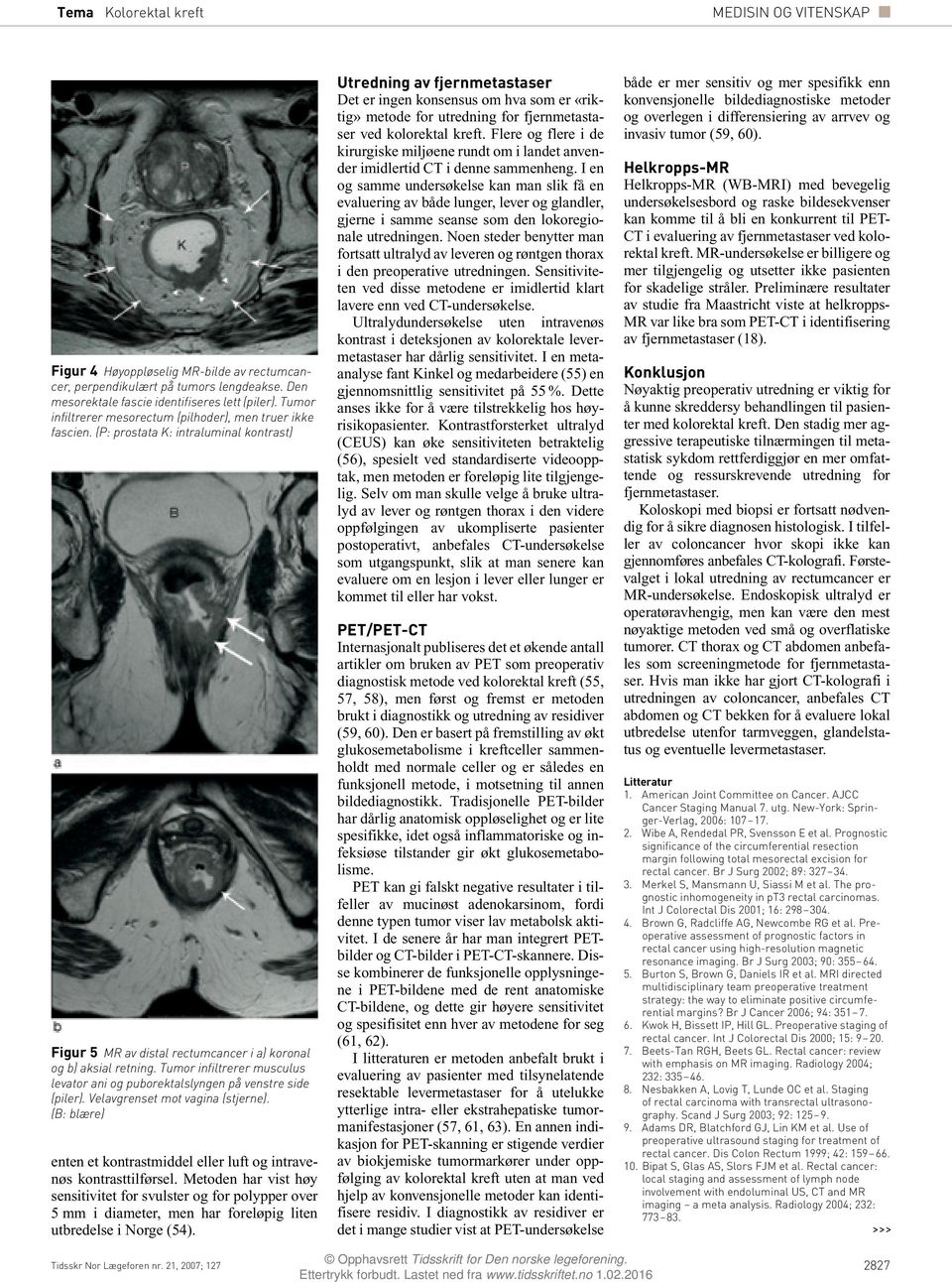 Tumor infiltrerer musculus levator ani og puborektalslyngen på venstre side (piler). Velavgrenset mot vagina (stjerne). (B: blære) enten et kontrastmiddel eller luft og intravenøs kontrasttilførsel.