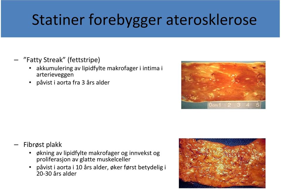 Fibrøst plakk økning av lipidfylte makrofager og innvekst og proliferasjon av