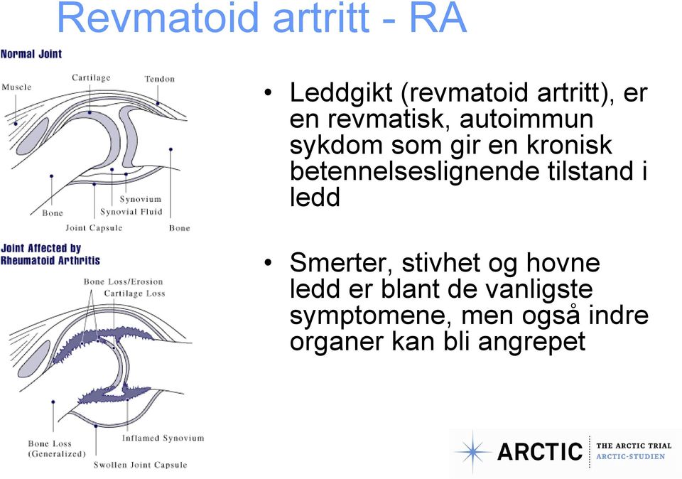 betennelseslignende tilstand i ledd Smerter, stivhet og hovne