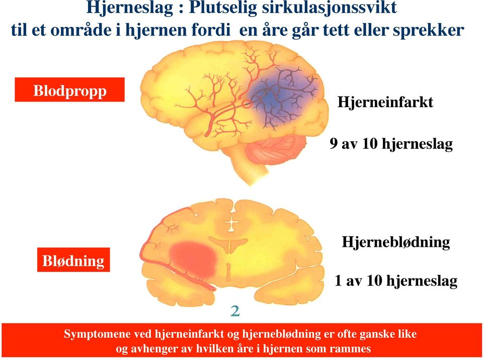 Blødning Hjerneblødning 1 av 10 hjerneslag Symptomene ved hjerneinfarkt og