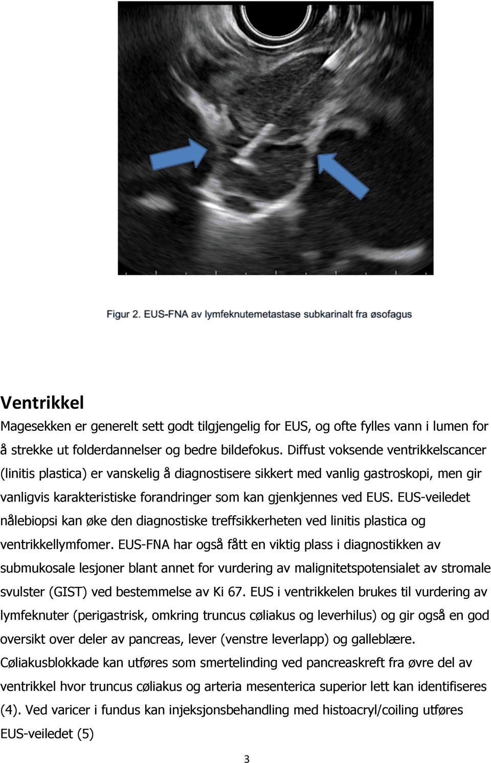 EUS-veiledet nålebiopsi kan øke den diagnostiske treffsikkerheten ved linitis plastica og ventrikkellymfomer.