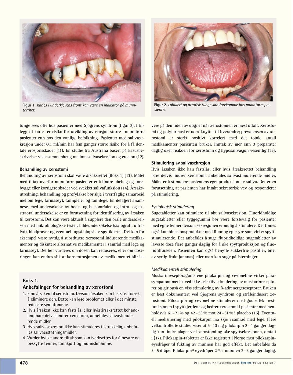 Pasienter med salivasekresjon under 0,1 ml/min har fem ganger større risiko for å få dentale erosjonsskader (11).
