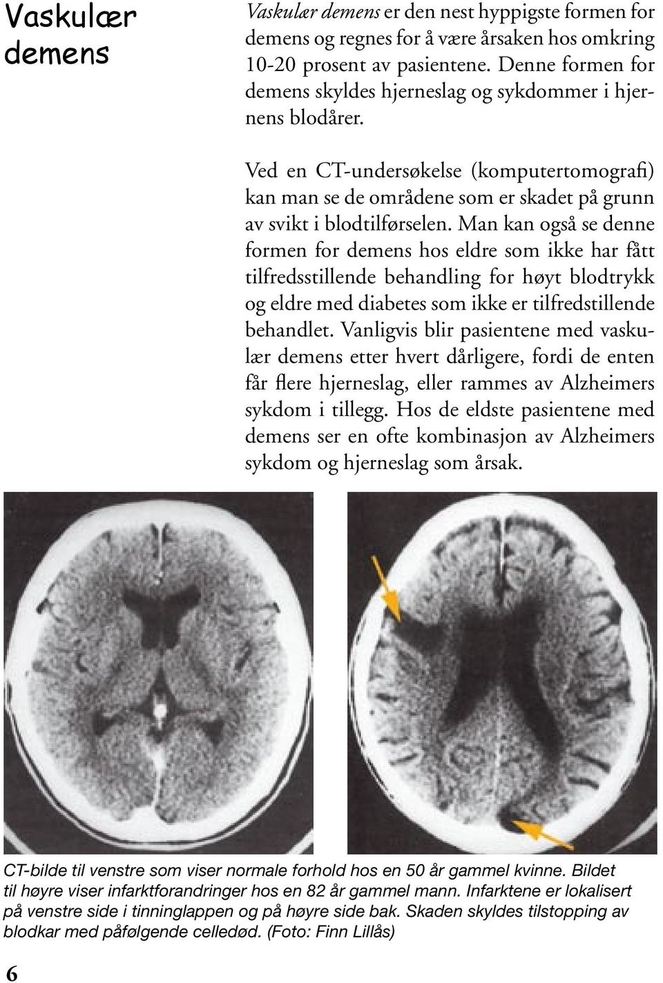 Man kan også se denne formen for demens hos eldre som ikke har fått tilfredsstillende behandling for høyt blodtrykk og eldre med diabetes som ikke er tilfredstillende behandlet.