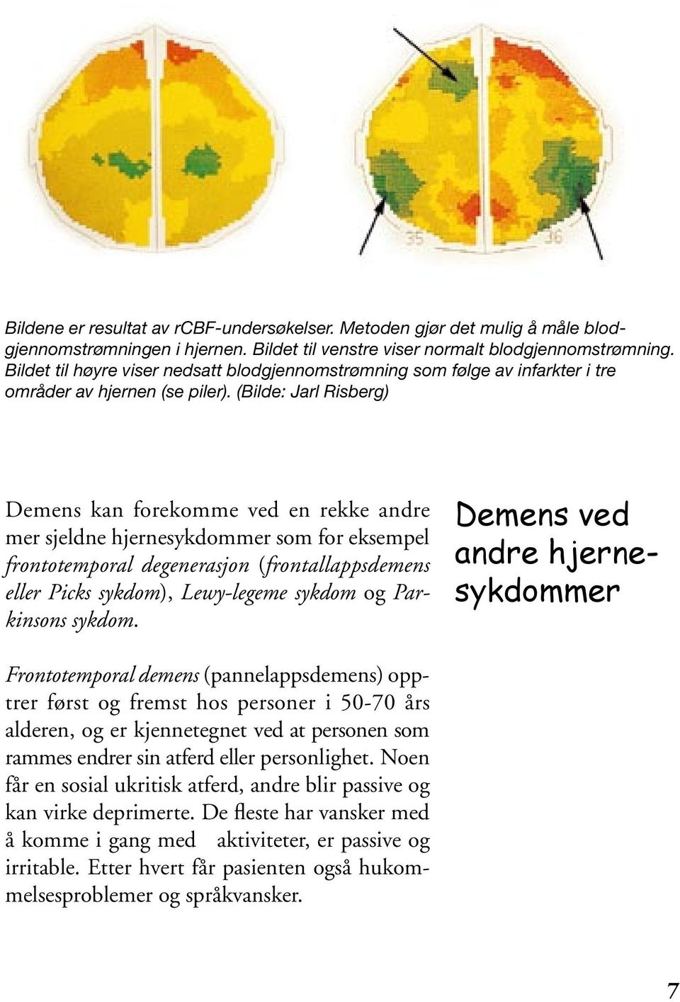 (Bilde: Jarl Risberg) Demens kan forekomme ved en rekke andre mer sjeldne hjernesykdommer som for eksempel fronto temporal degenerasjon (frontallappsdemens eller Picks sykdom), Lewy-legeme sykdom og