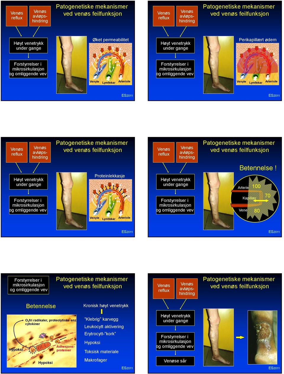 reflux avløpshindring Patogenetiske mekanismer ved venøs feilfunksjon reflux avløpshindring Patogenetiske mekanismer ved venøs feilfunksjon Betennelse!