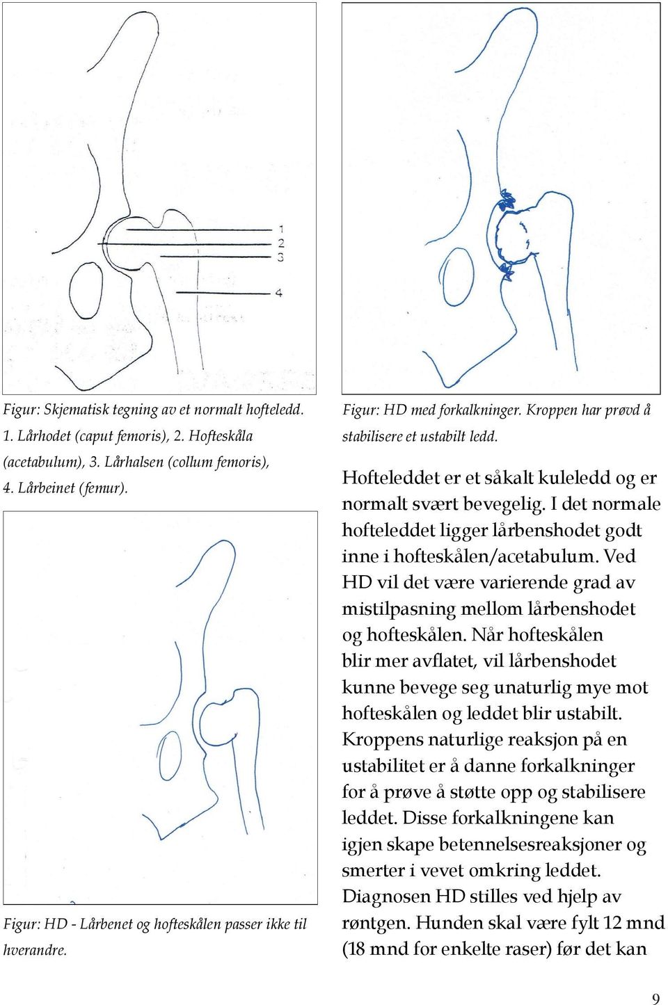 Hofteleddet er et såkalt kuleledd og er normalt svært bevegelig. I det normale hofteleddet ligger lårbenshodet godt inne i hofteskålen/acetabulum.